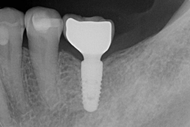 歯科用インプラント