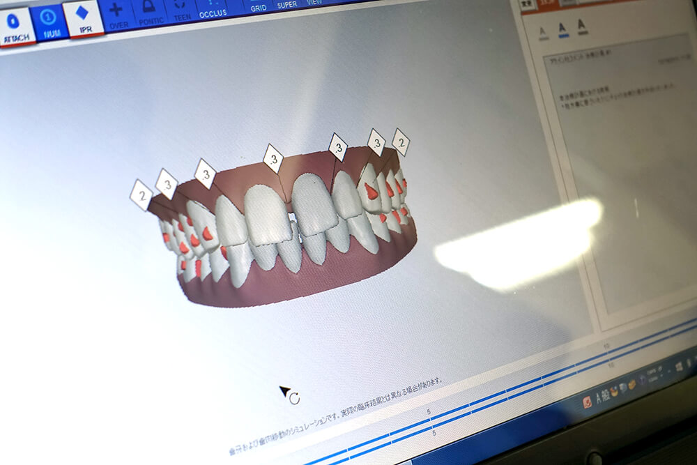 インビザライン 3Dシミュレーション