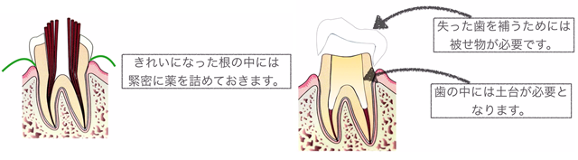 神経を抜き消毒した後、根の中を封鎖する薬をいれて根の治療は完了