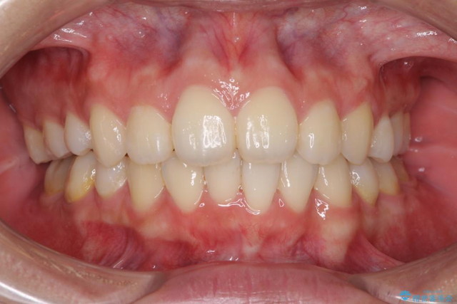 特徴3：歯を抜かない矯正 アフター