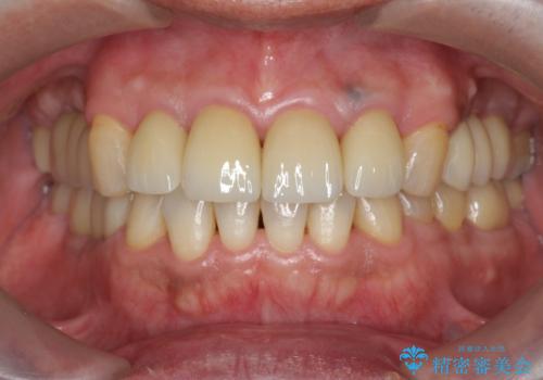 「放置した虫歯」 前歯セラミック治療