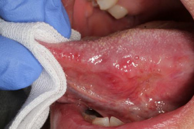 舌・口腔粘膜の検査