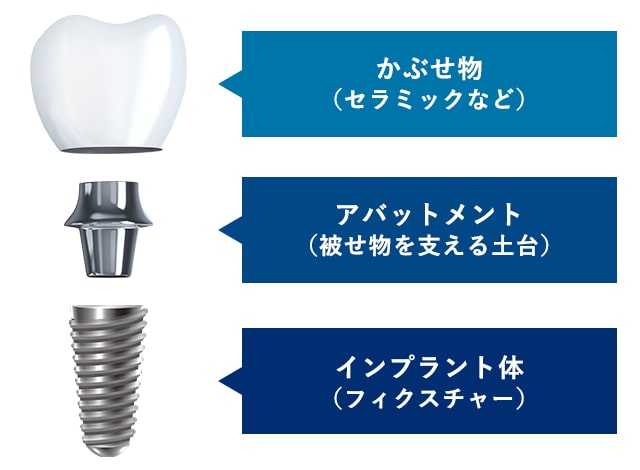 インプラントとは