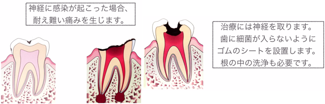 歯の神経への感染が起こると、反応として炎症が起こります