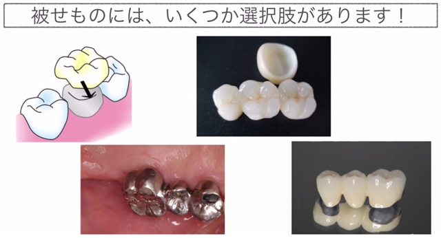 被せ物にはいくつか選択肢があります