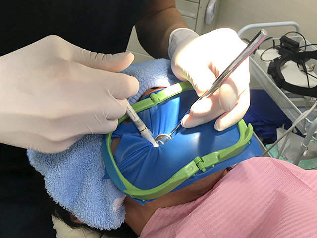 歯内療法におけるラバーダムの重要性：最新技術だけでは不十分