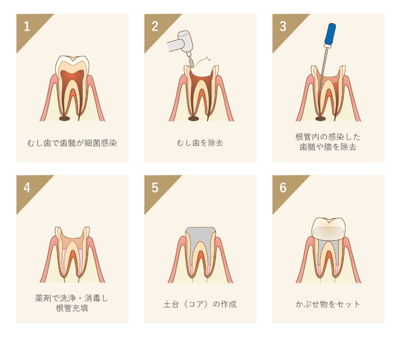 根管治療の流れ