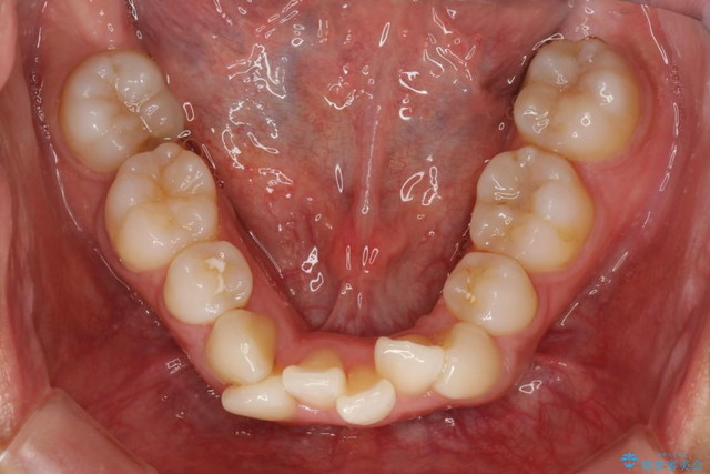 特徴3：歯を抜かない矯正 ビフォー