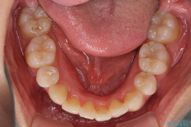 特徴3：歯を抜かない矯正 アフター