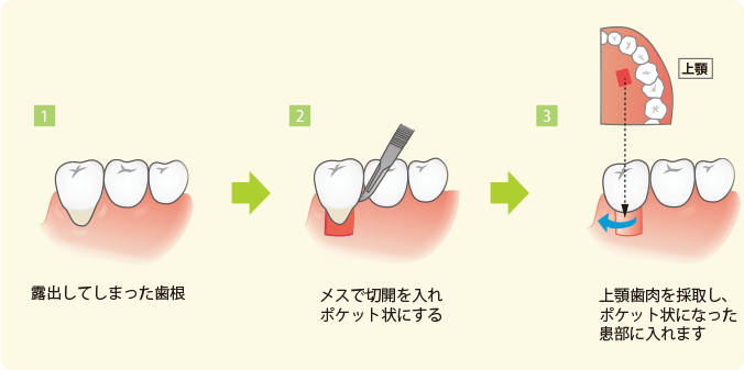 歯周外科治療