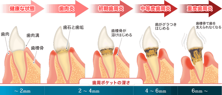 歯周ポケット