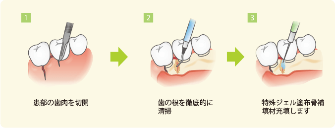 歯周外科治療