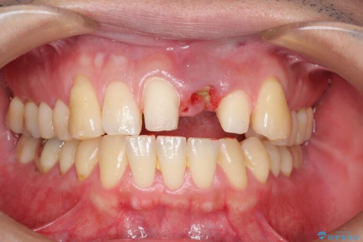 前歯のブリッジ治療 治療途中画像
