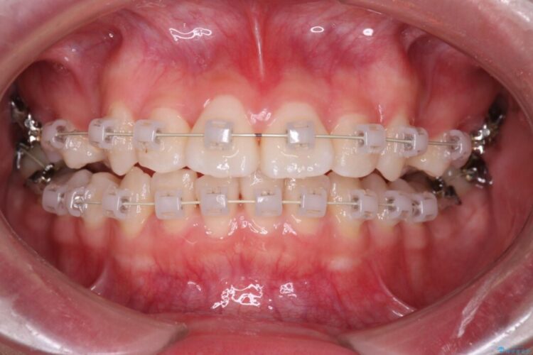抜歯矯正で口元スッキリ きれいな笑顔に 治療途中画像