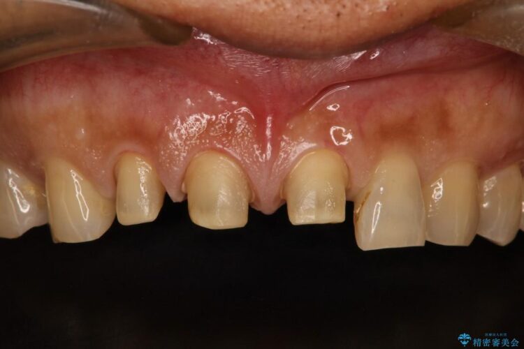オールセラミックで前歯の隙間を改善 治療途中画像
