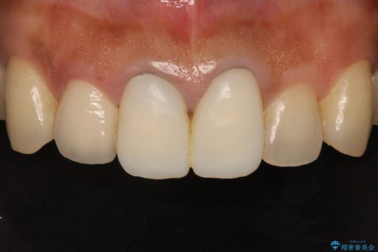 前歯の黒ずみをオールセラミックで改善 治療途中画像