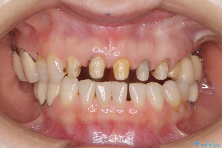 歯茎との境目が黒くなってきた差し歯のオールセラミック治療 治療途中画像