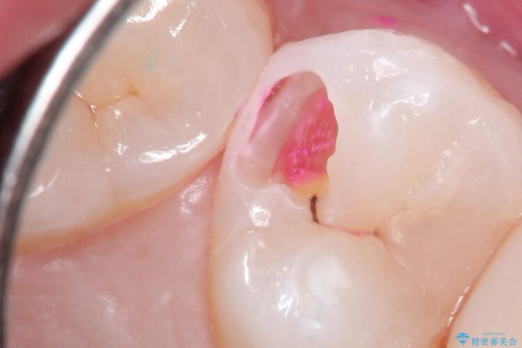 早期発見・早期むし歯治療(セラミックインレーにて修復) 治療途中画像