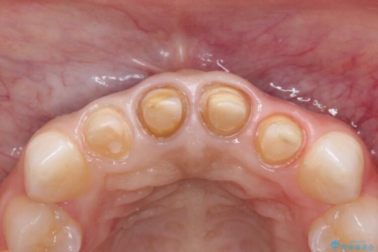 精密治療による前歯の被せ物 治療途中画像