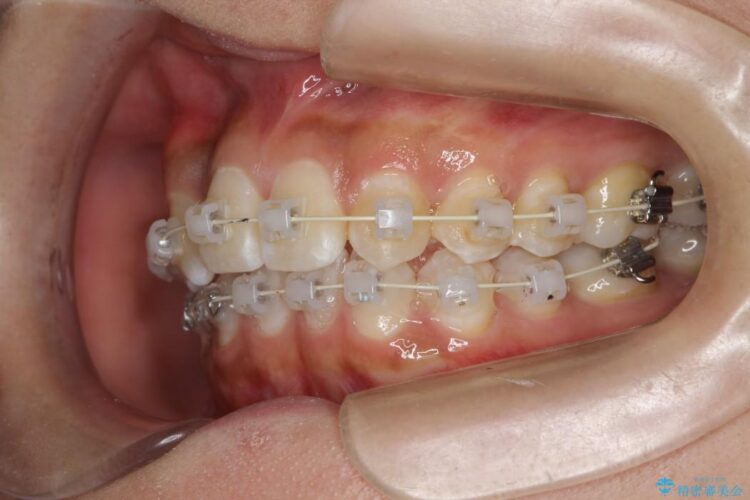 残っていた乳歯を抜歯して矯正治療 治療途中画像