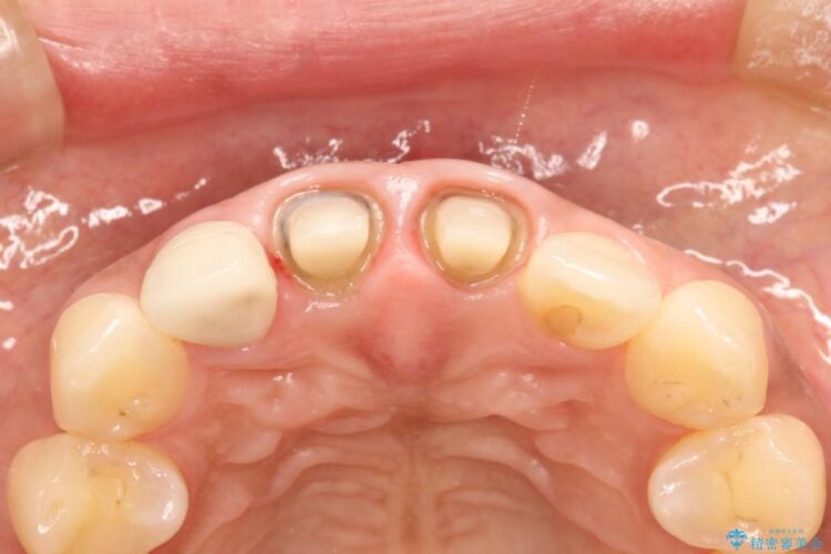 前歯の黒ずみをオールセラミックで改善 治療途中画像