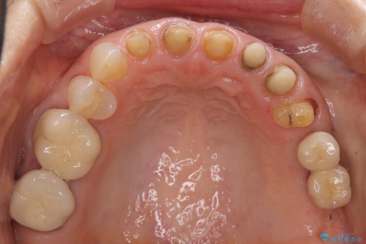 歯茎との境目が黒くなってきた差し歯のオールセラミック治療 治療途中画像