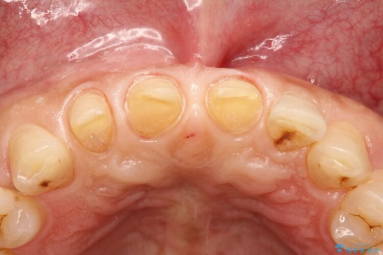 オールセラミックで前歯の隙間を改善 治療途中画像