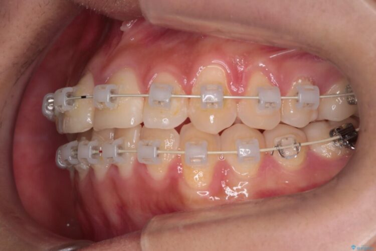 審美装置による非抜歯ワイヤー矯正治療 治療途中画像