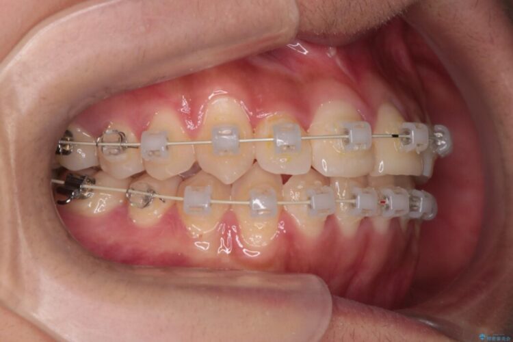 審美装置による非抜歯ワイヤー矯正治療 治療途中画像