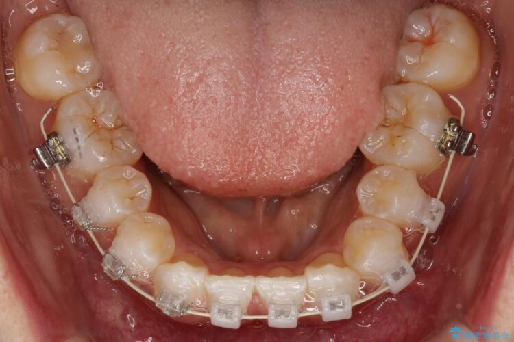 残っていた乳歯を抜歯して矯正治療 治療途中画像