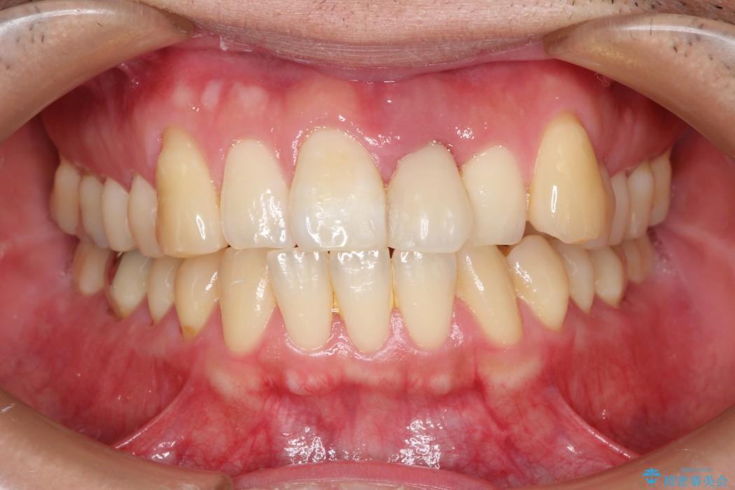 前歯のブリッジ治療 治療前