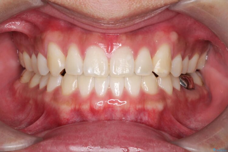 オフィスホワイトニングで歯を白く（エクセレントコース） 治療前画像