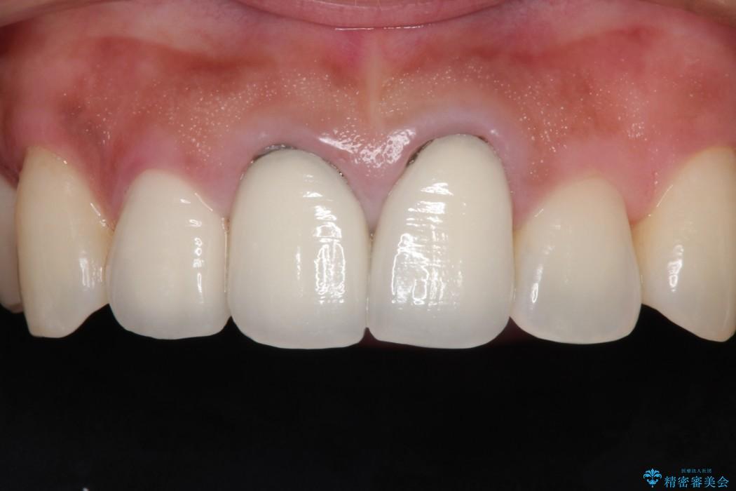 前歯の黒ずみをオールセラミックで改善 治療前