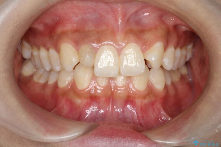 残っていた乳歯を抜歯して矯正治療 治療前画像