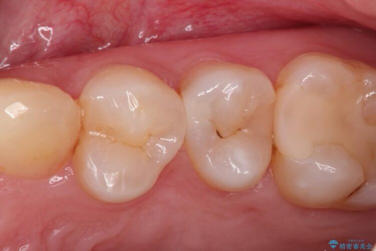 早期発見・早期むし歯治療(セラミックインレーにて修復) ビフォー