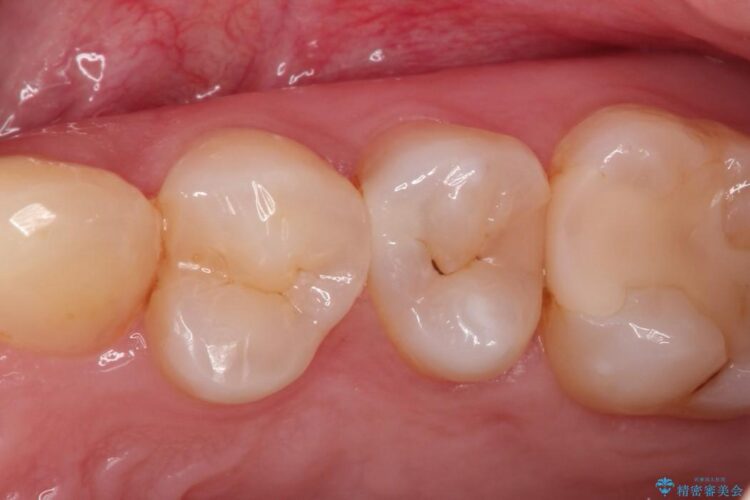 早期発見・早期むし歯治療(セラミックインレーにて修復) 治療前画像