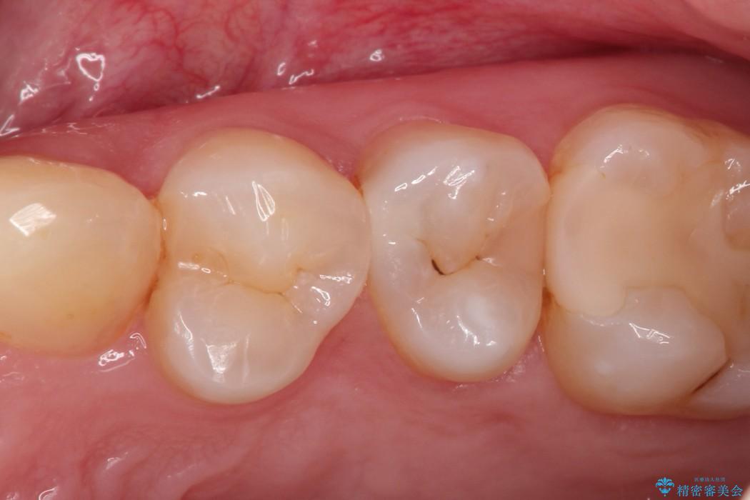 早期発見・早期むし歯治療(セラミックインレーにて修復) 治療前