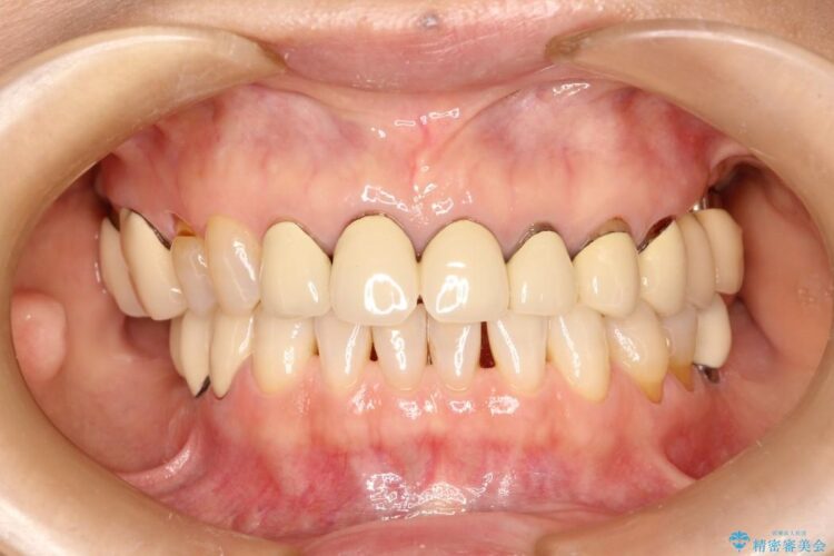 歯茎との境目が黒くなってきた差し歯のオールセラミック治療 治療前画像