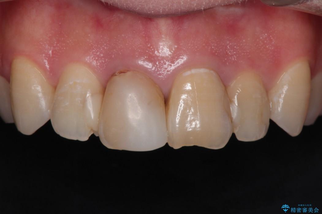 精密治療による前歯の被せ物 治療前