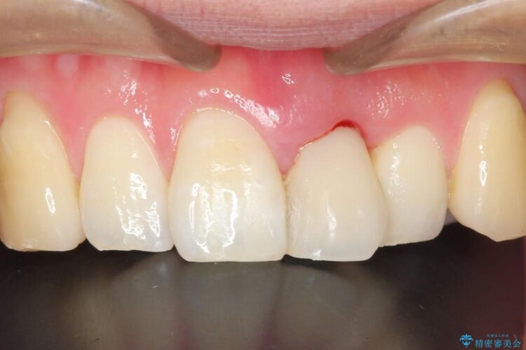 前歯のブリッジ治療 治療前画像
