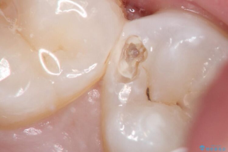 早期発見・早期むし歯治療(セラミックインレーにて修復) 治療前画像