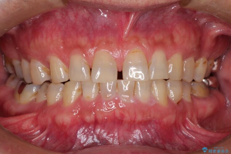 オールセラミックで前歯の隙間を改善 治療前画像