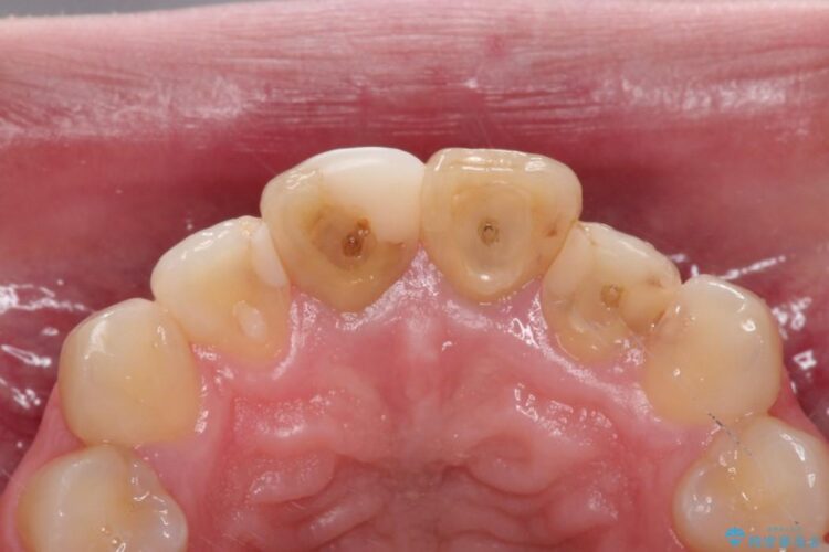 精密治療による前歯の被せ物 治療前画像