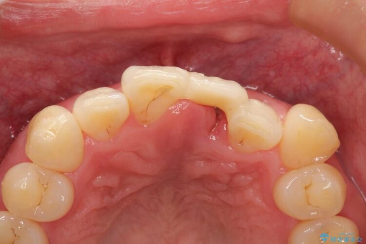 前歯のブリッジ治療 治療前画像