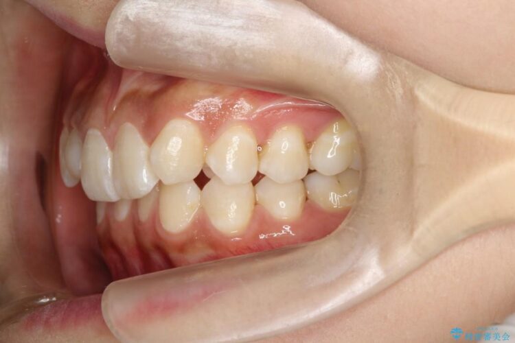 残っていた乳歯を抜歯して矯正治療 治療前画像
