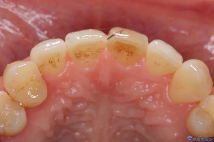 気になる前歯の変色をセラミックのかぶせ物で治療 治療前画像