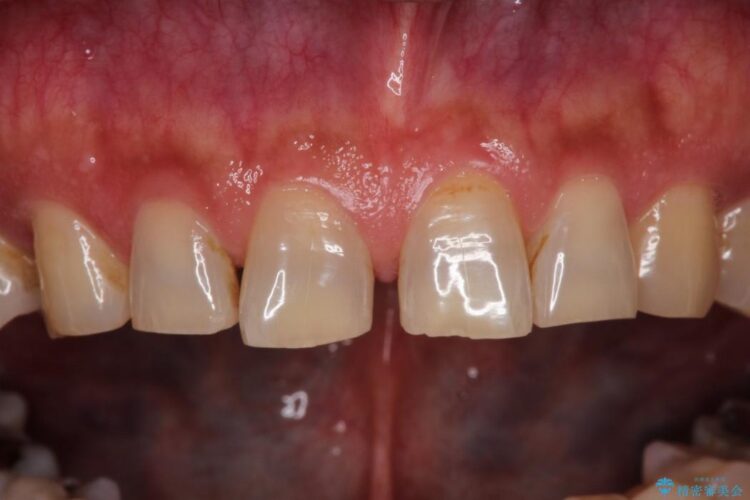 オールセラミックで前歯の隙間を改善 治療前画像