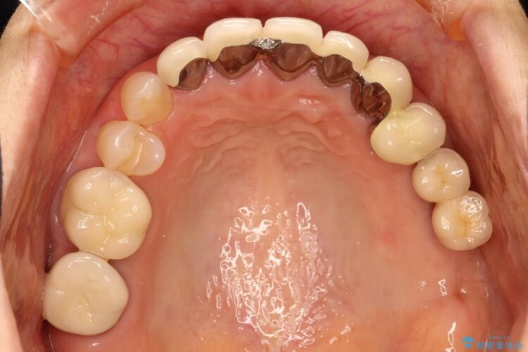 歯茎との境目が黒くなってきた差し歯のオールセラミック治療 治療前画像