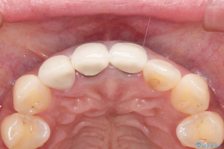 前歯の黒ずみをオールセラミックで改善 治療前画像