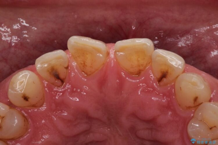 オールセラミックで前歯の隙間を改善 治療前画像